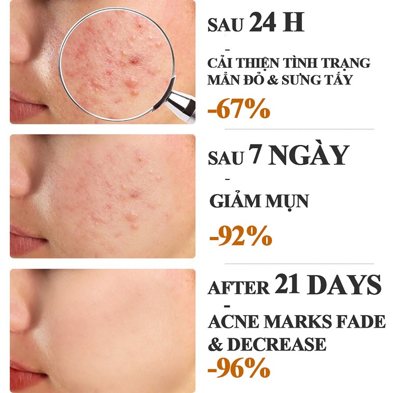 Kem chấm mụn Gel 20g giảm mụn, giảm thâm ngăn mụn tái phát, kem bôi mụn làm mờ thâm mụn