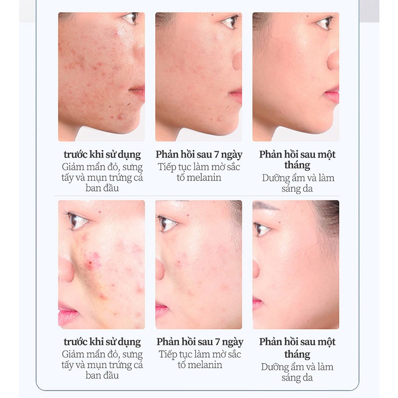 Kem chấm mụn Gel 20g giảm mụn, giảm thâm ngăn mụn tái phát, kem bôi mụn làm mờ thâm mụn