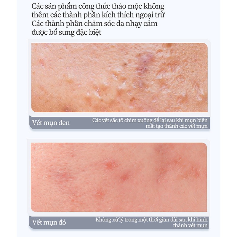Kem chấm mụn Gel 20g giảm mụn, giảm thâm ngăn mụn tái phát, kem bôi mụn làm mờ thâm mụn