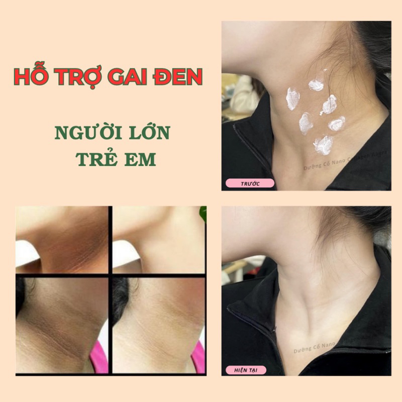 Kem Dưỡng Da Cổ Loka Nano Abera 50ML Có Lăn Massage chăm sóc, phục hồi da cổ, lấy lại sự đàn hồi của tuổi xuân