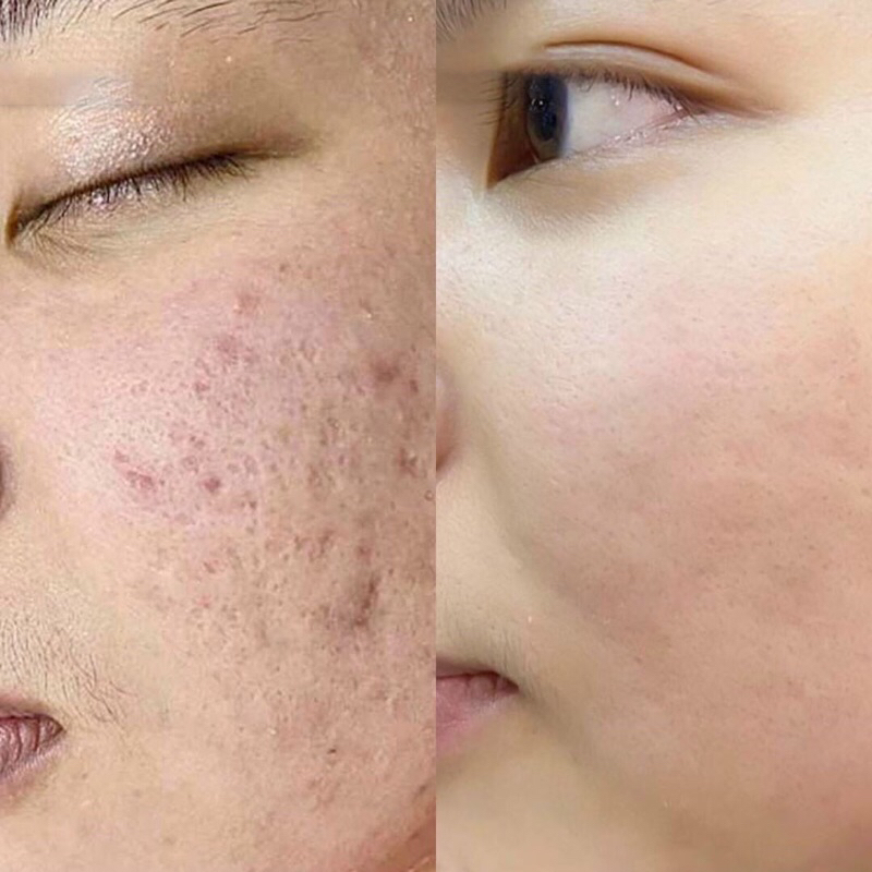 Mầm sẹo collagen đầy sẹo rỗ xoá thâm
