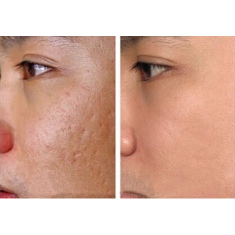 Mầm sẹo collagen đầy sẹo rỗ xoá thâm