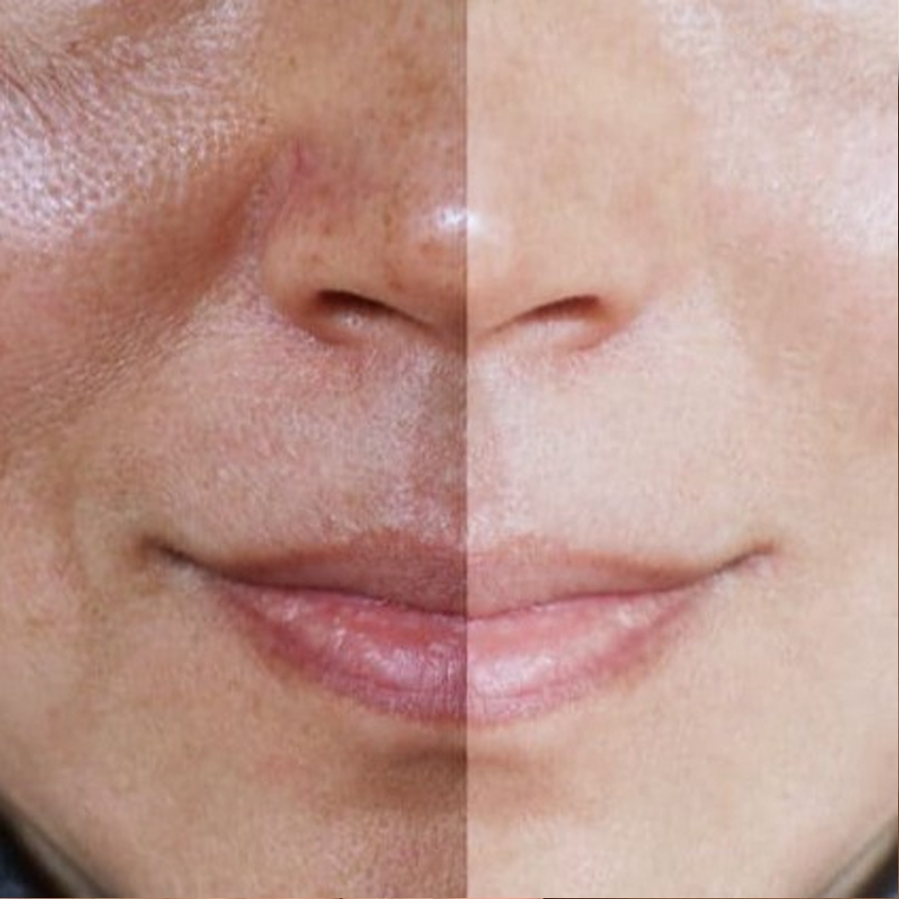 Viên cao nám whoo radiant white ultimate corrector chuyên xóa sạch nám tàn nhang và làm da trắng đều màu