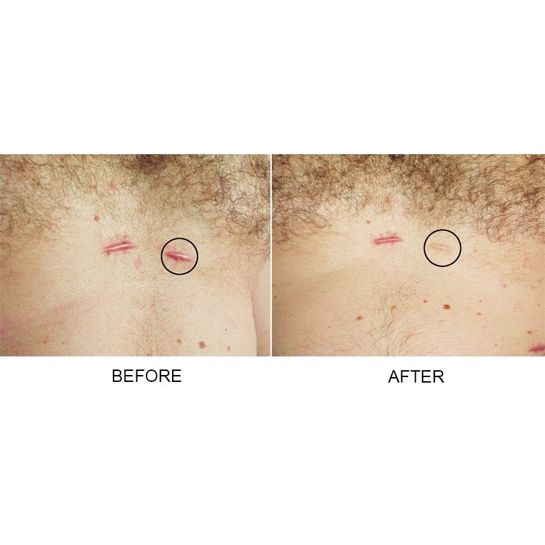 Kem xoá Mờ Sẹo Rỗ, Sẹo Thâm, Sẹo Lõm, Sẹo Thuỷ Đậu, Tai Nạn Strataderm 20g Thuỵ Sĩ