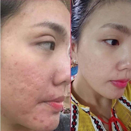 Kem xoá Mờ Sẹo Rỗ, Sẹo Thâm, Sẹo Lõm, Sẹo Thuỷ Đậu, Tai Nạn Strataderm 20g Thuỵ Sĩ