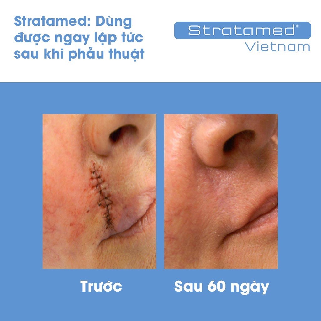 Gel phục hồi vết thương hở sau phẫu thuật, ngăn ngừa sẹo thâm, sẹo rỗ, sẹo lõm, sẹo phì đại Stratamed Thuỵ Sĩ