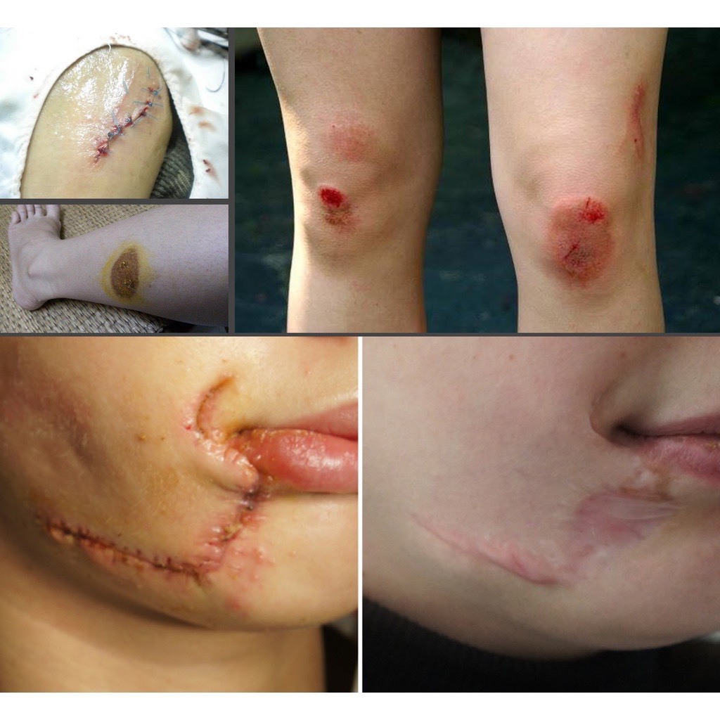 Gel phục hồi vết thương hở sau phẫu thuật, ngăn ngừa sẹo thâm, sẹo rỗ, sẹo lõm, sẹo phì đại Stratamed Thuỵ Sĩ