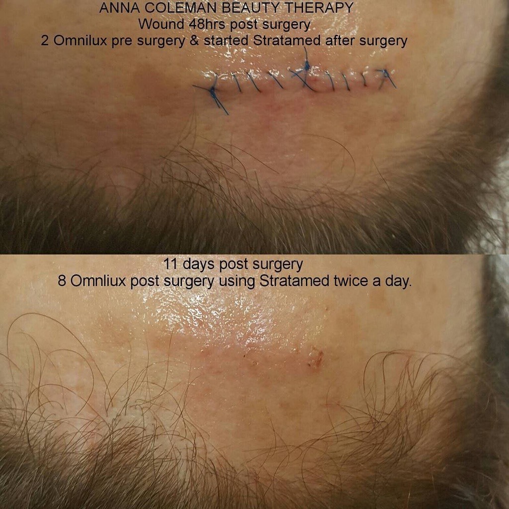 Gel phục hồi vết thương hở sau phẫu thuật, ngăn ngừa sẹo thâm, sẹo rỗ, sẹo lõm, sẹo phì đại Stratamed Thuỵ Sĩ