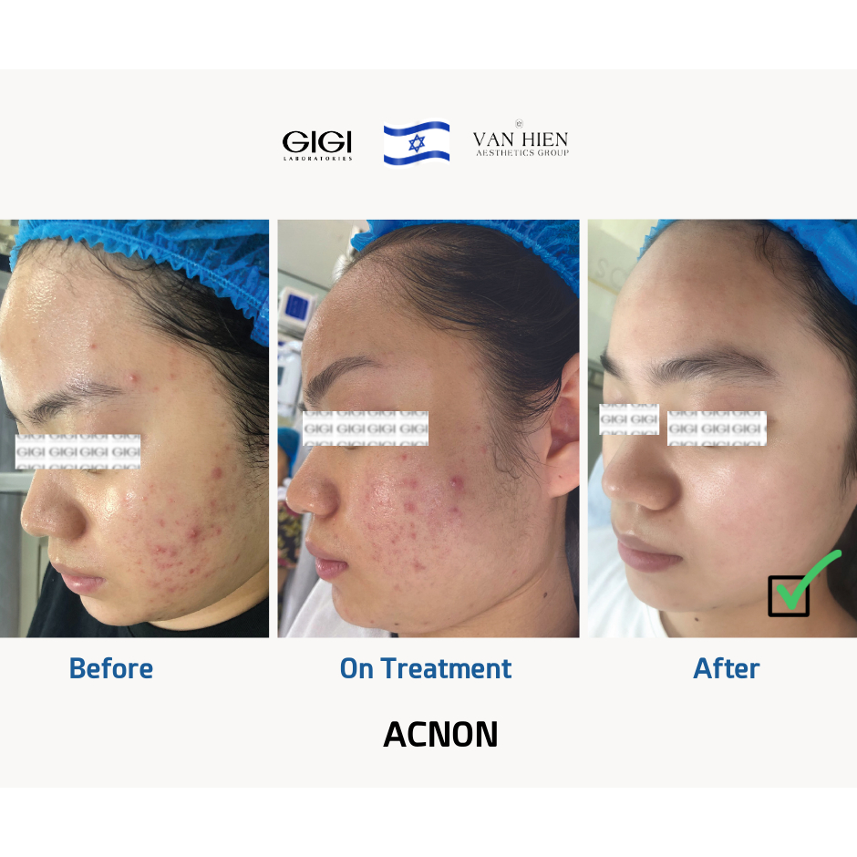 Kem dưỡng ban đêm dành cho da dầu mụn GIGI ACNON OVERNIGHT TREATMENT 50ml