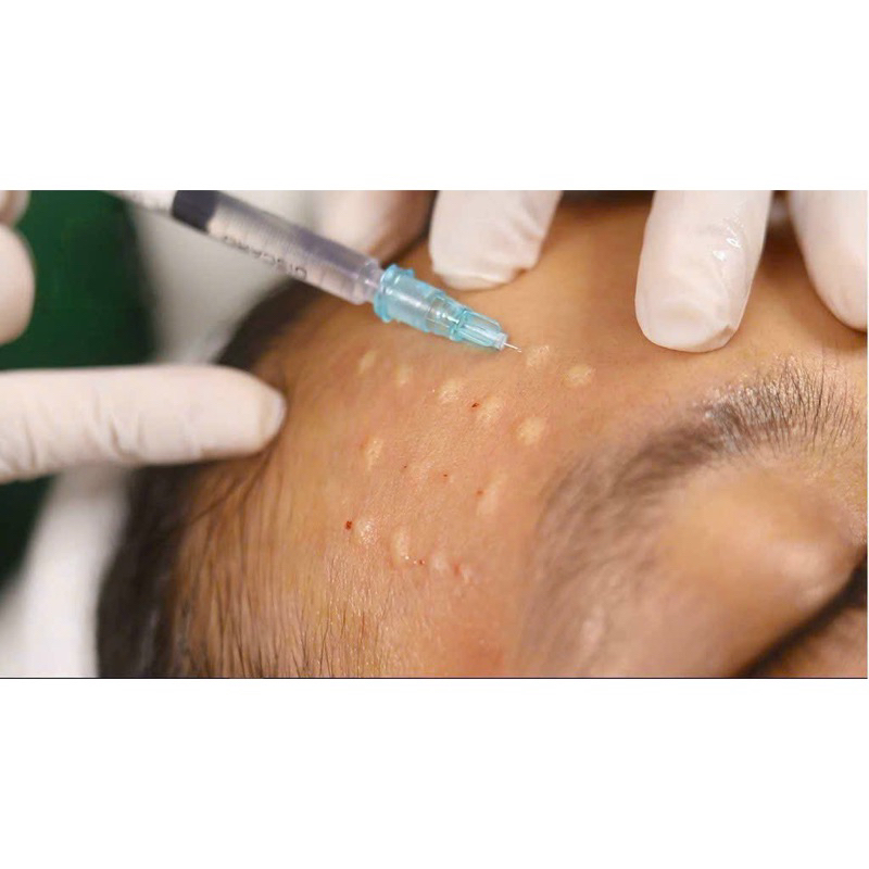 Kim tiêm meso 34G.4mm  - Kim Tiêm Meso 34g-4mm Sharp Needle