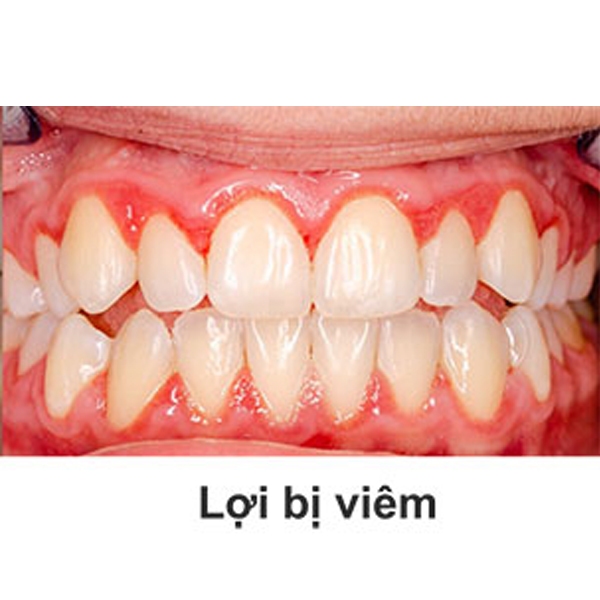 Combo 2 Kem Đánh Răng Muối Tre Chăm Sóc Nướu Số 1 Hàn Quốc 140g