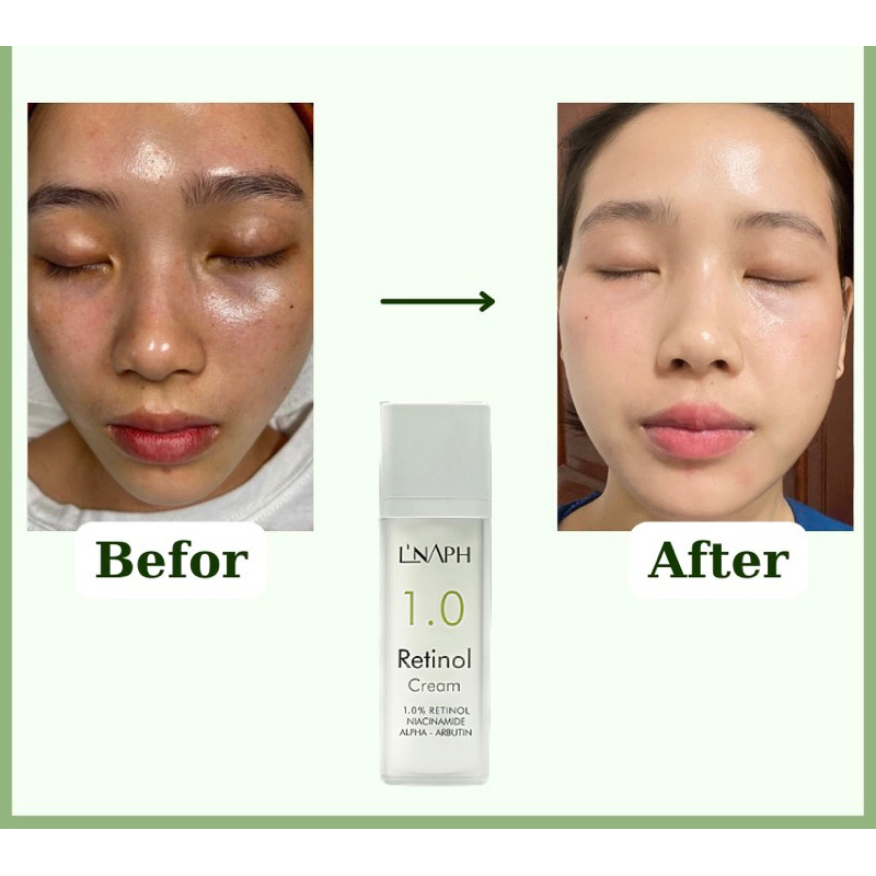 Kem dưỡng LNAPH Retinol Cream