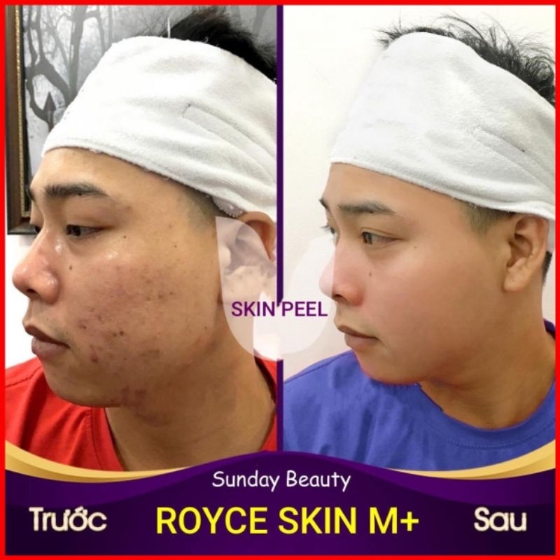 Peel da ROYCE SKIN M+ Thay da toàn diện tái tạo vẻ đẹp tiềm năng .