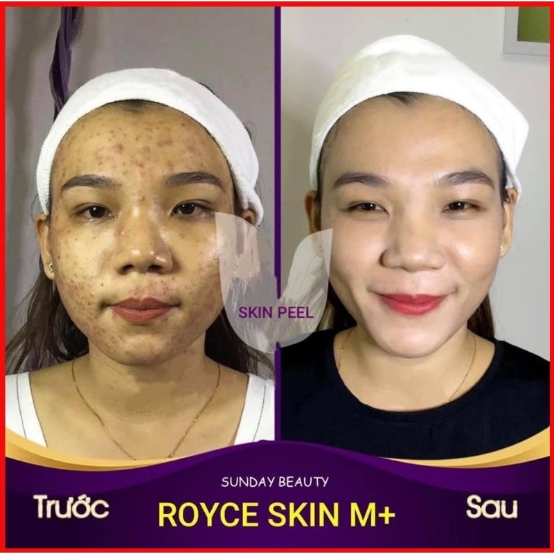 Peel da ROYCE SKIN M+ Peel da tiện lợi dễ sử dụng .
