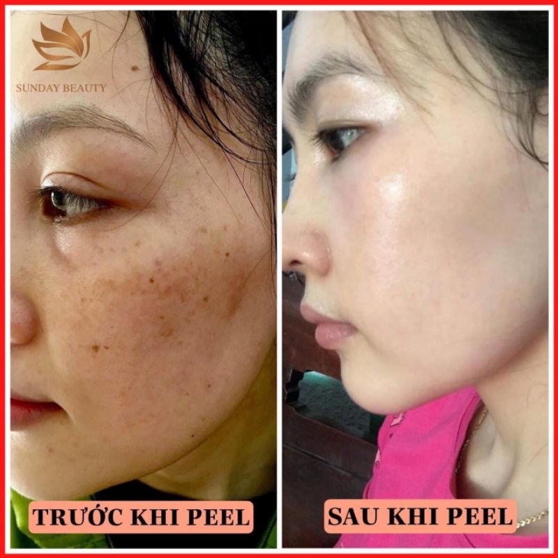 Peel da ROYCE SKIN M+ Peel da sinh học chuẩn minh tinh .