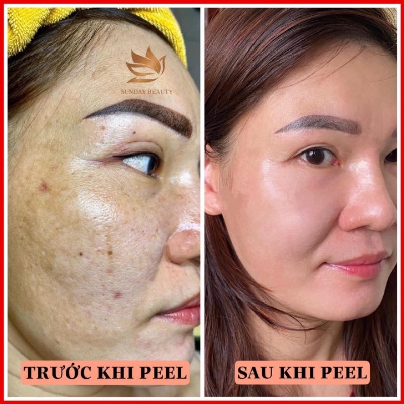 Peel da ROYCE SKIN M+ Peel da bí quyết trẻ hoá da thách thức thời gian .