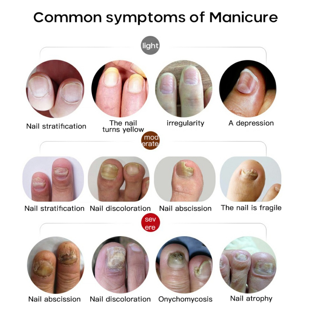 Tinh chất nấm móng tay chân, dứt điểm KT2