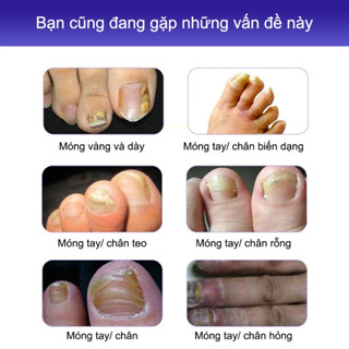 Tinh chất nấm móng tay chân, dứt điểm KT2