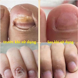 Tinh chất nấm móng tay chân, dứt điểm KT2