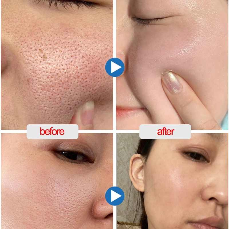 Serum trắng da Serum se khít lỗ chân lông 30ML lột mụn đầu đen se khít lỗ