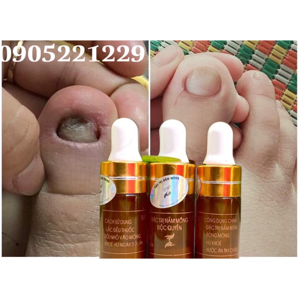 Serum đánh bay nấm móng, hư khoé, bọng móng, nước ăn tay chân gia truyền 4ml
