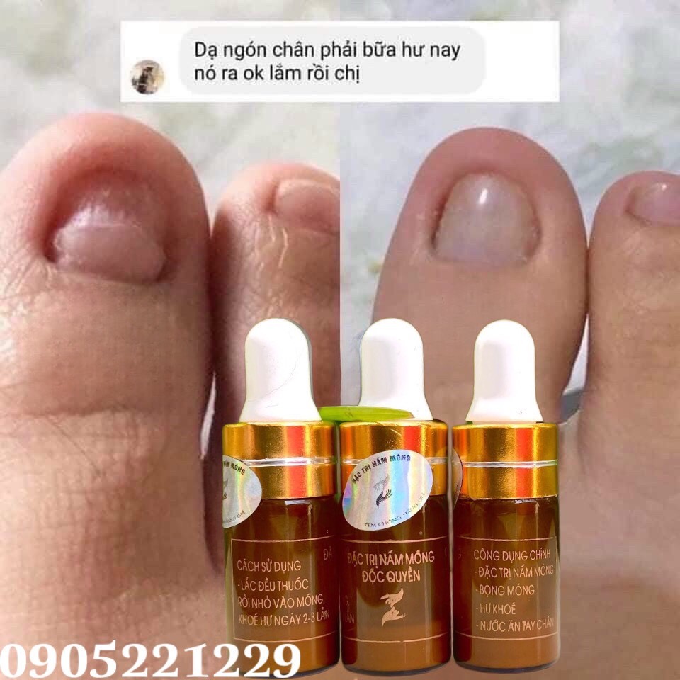Serum đánh bay nấm móng, hư khoé, bọng móng, nước ăn tay chân gia truyền 4ml