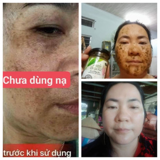 Mặt nạ chuyên nám, tàn nhang, mụn ẩn cô gái núi