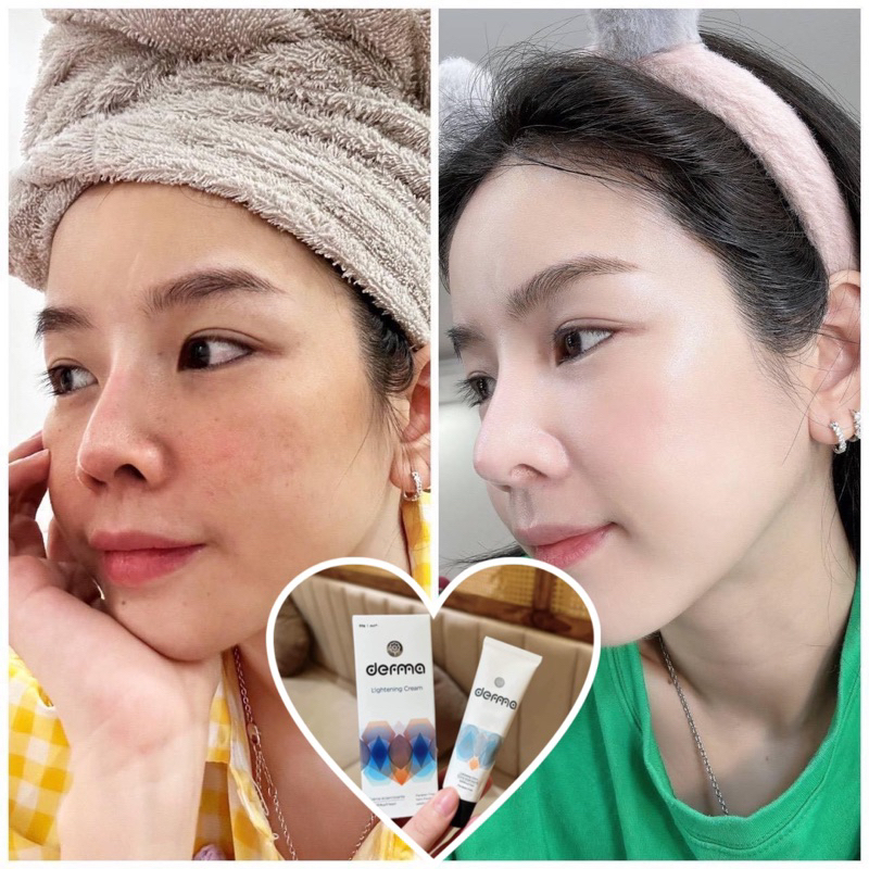 Kem dưỡng da, mờ nám và tàn nhang Derma Lightening Cream