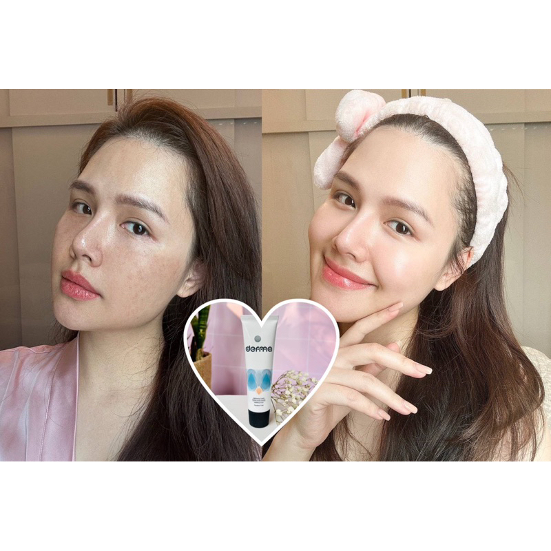 Kem dưỡng da, mờ nám và tàn nhang Derma Lightening Cream