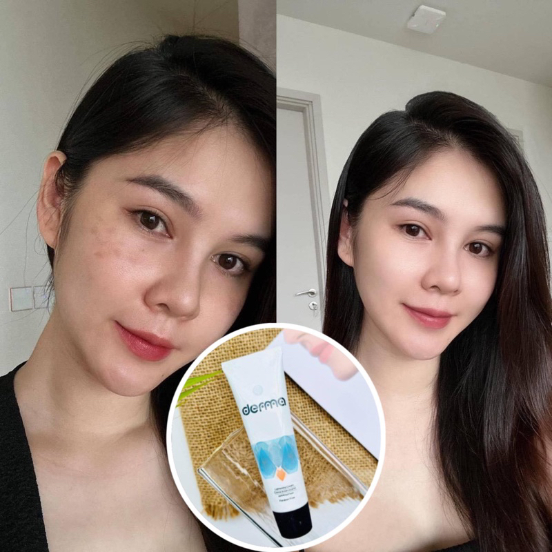 Kem dưỡng da, mờ nám và tàn nhang Derma Lightening Cream