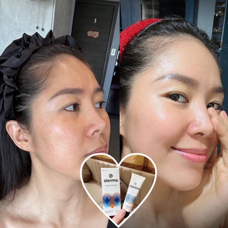Kem dưỡng da, mờ nám và tàn nhang Derma Lightening Cream