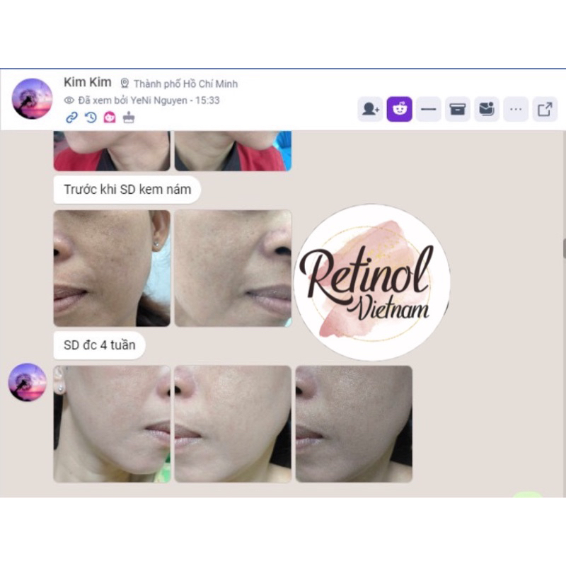 Kem dưỡng da, mờ nám và tàn nhang Derma Lightening Cream