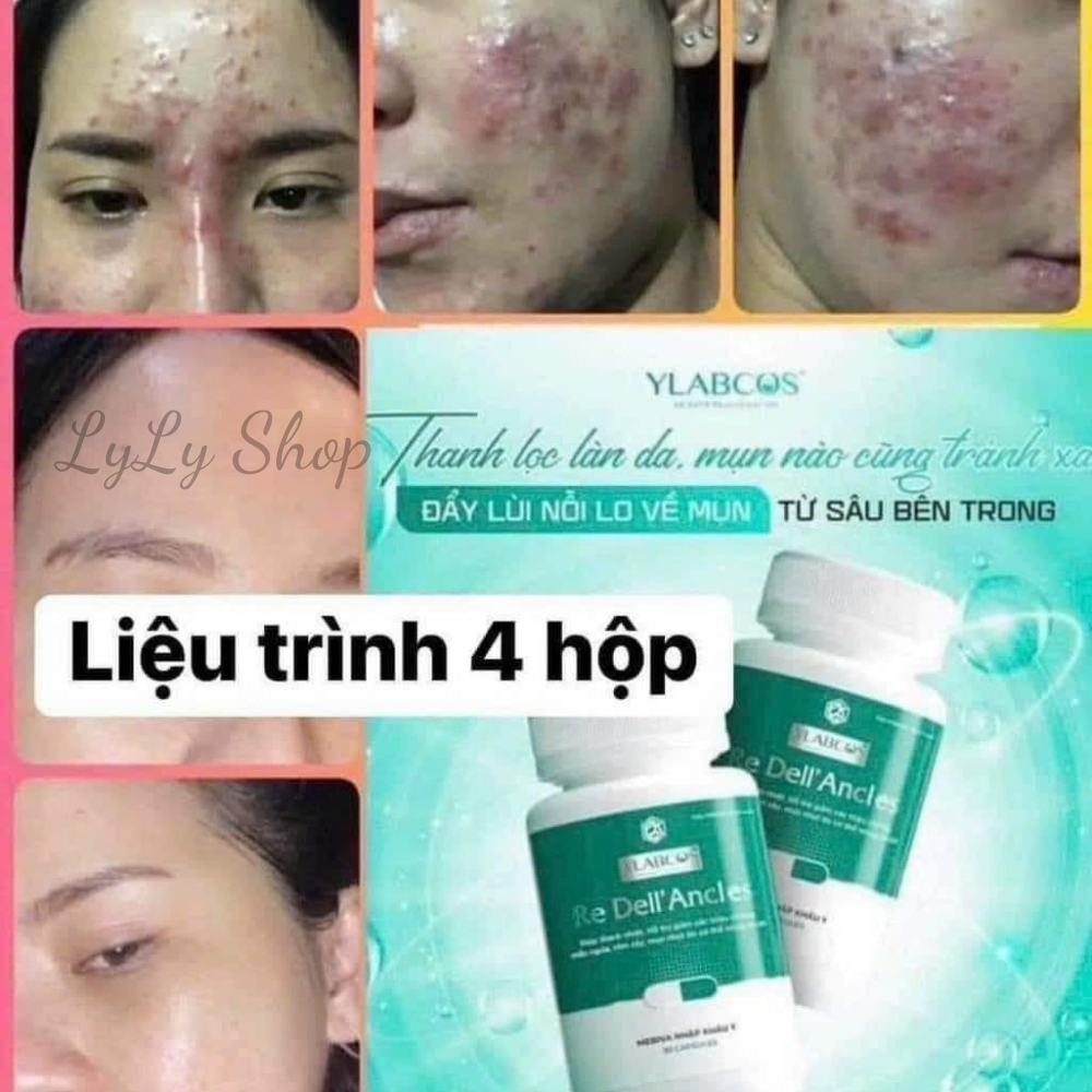 Viên Uống Giảm Mụn Re Dell' Ancles Dr.Lacir, Cải thiện giảm mụn hiệu quả, giảm nóng trong, ngăn ngừa mụn LyLyShop 30 viê