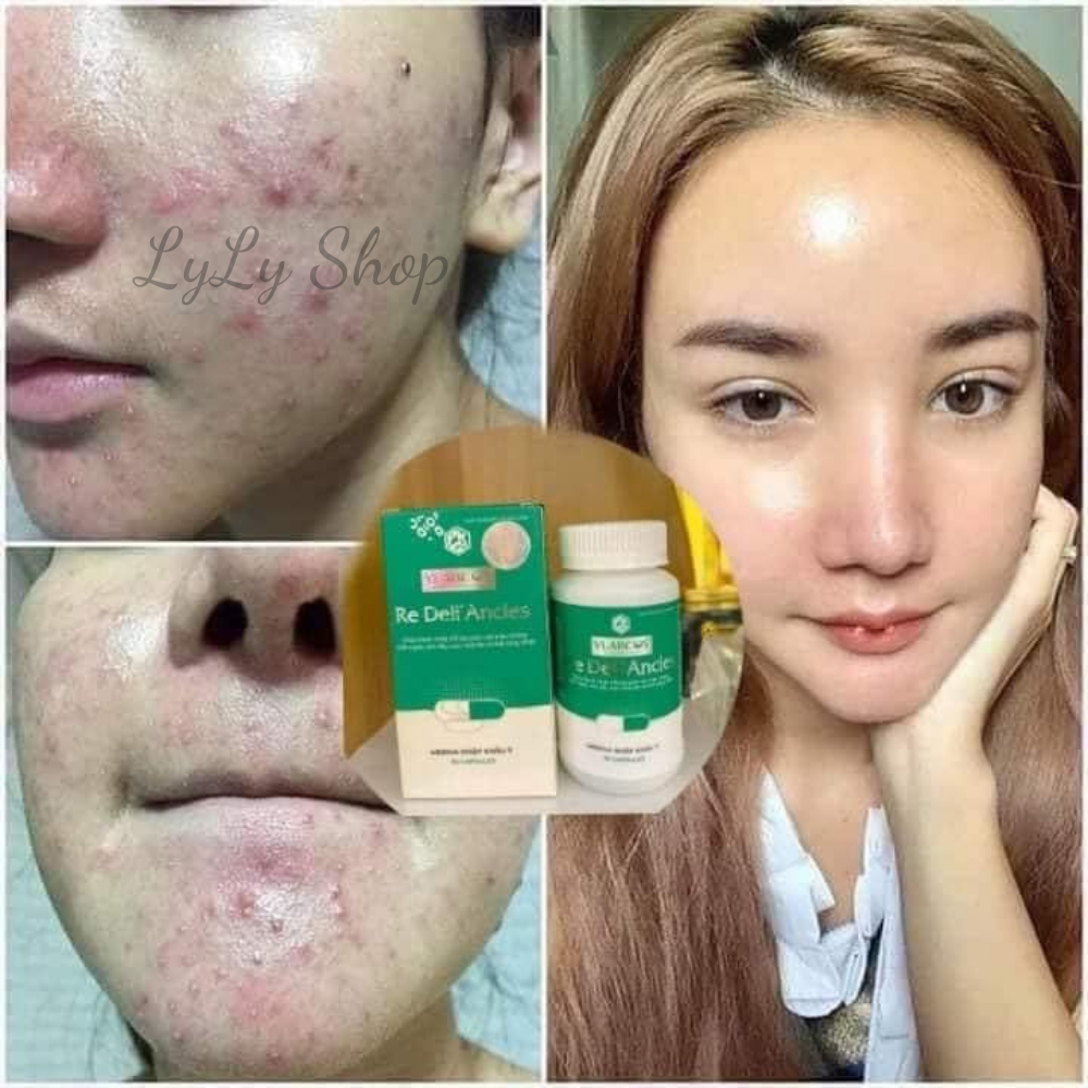 Viên Uống Giảm Mụn Re Dell' Ancles Dr.Lacir, Cải thiện giảm mụn hiệu quả, giảm nóng trong, ngăn ngừa mụn LyLyShop 30 viê