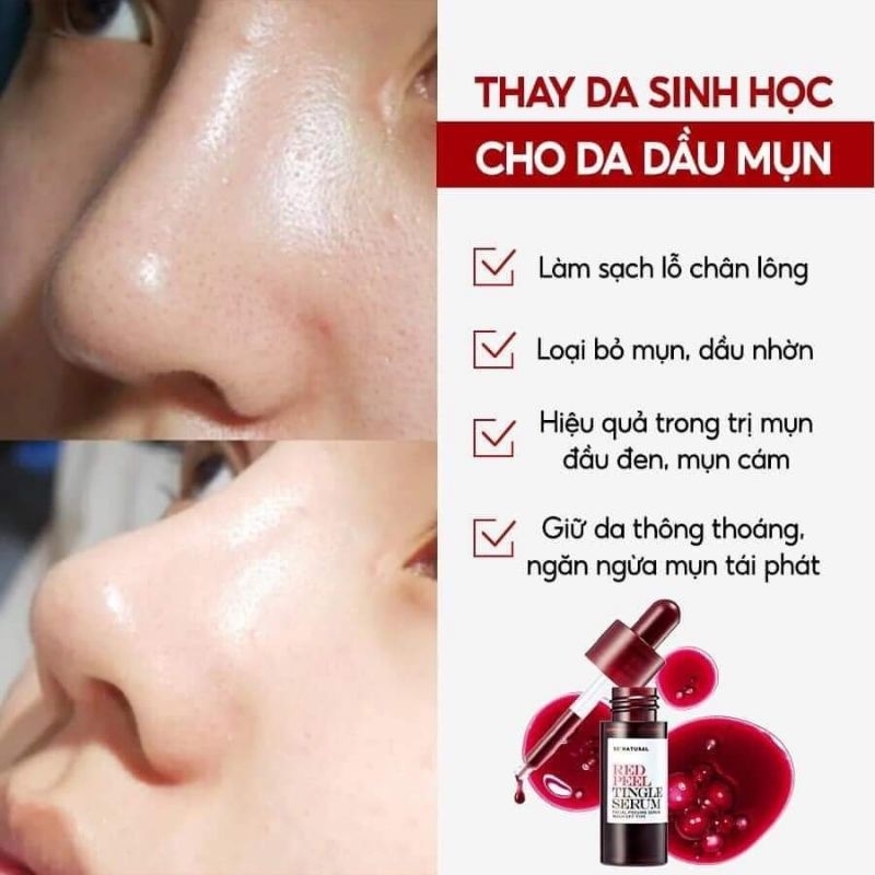 Tinh chất red peel tingle serum 10ml