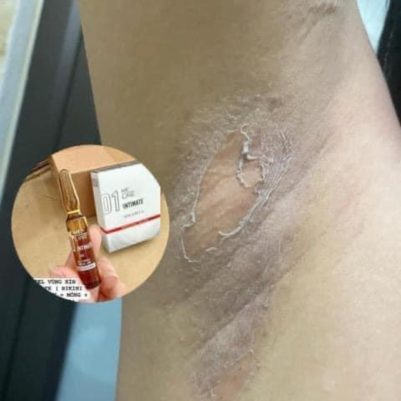 INTIMATE 01 MELINE,  tinh chất peel vùng kín  Innoaesthetics INNO