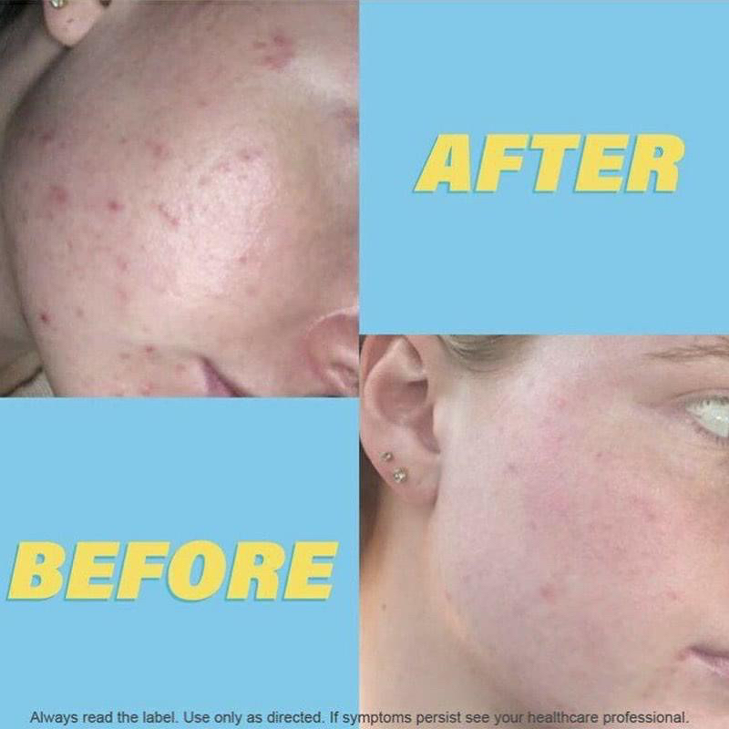 Kem Azclear Action Lotion 25g - Úc