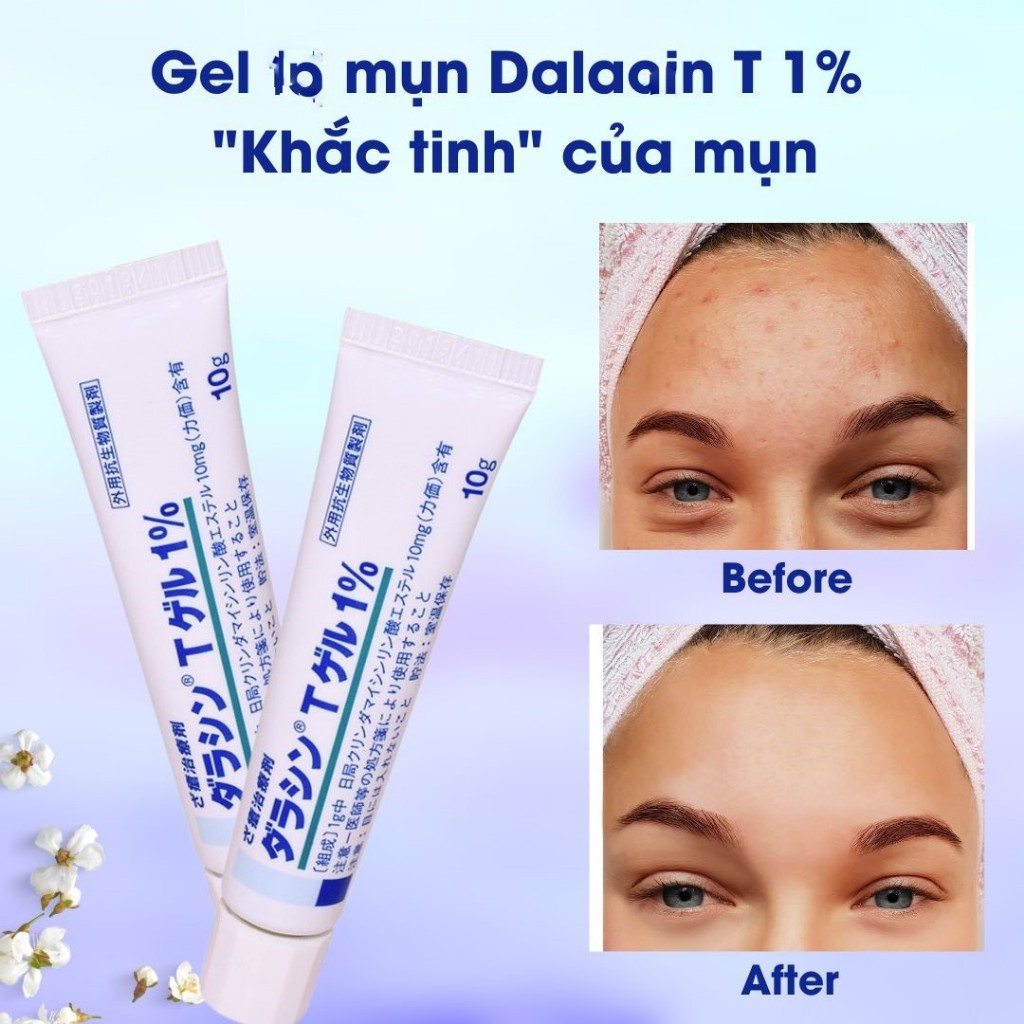 Kem gel giảm mụn Nhật Bản tuýp 10g, khắc tinh của các loại mụn, Gel mụn quốc dân tuýp 10g