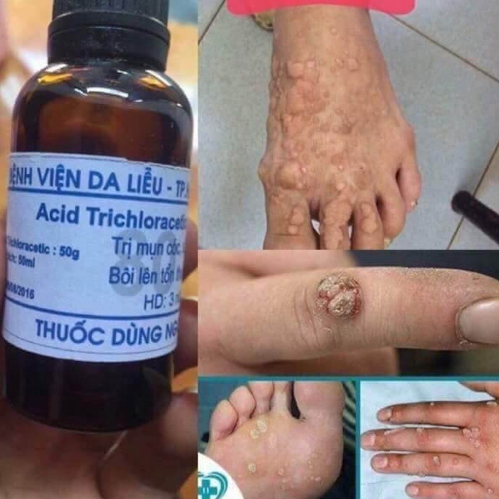 Loại bỏ mụn cóc, vết chai , mụn cơm , mắt cá chân hiệu quả