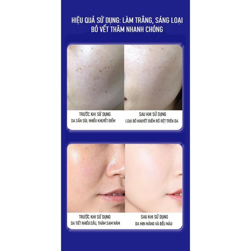 Kem UCM giảm nám, tàn nhang xóa nhăn, mờ nám trẻ hóa làn da-KIWI WIN