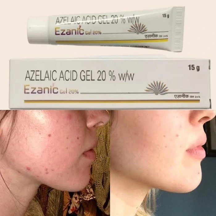 Kem giảm mụn Azelaic Acid 20 % Ezanic Gel, Cream dưỡng trắng da mờ thâm hiệu quả - Unipharma 15g