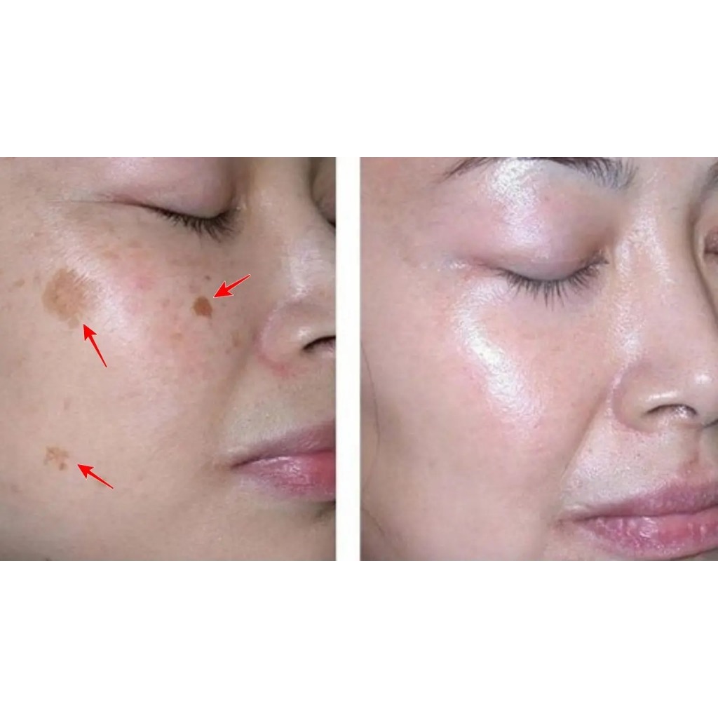 TCA Chấm Nám Tàn Nhang