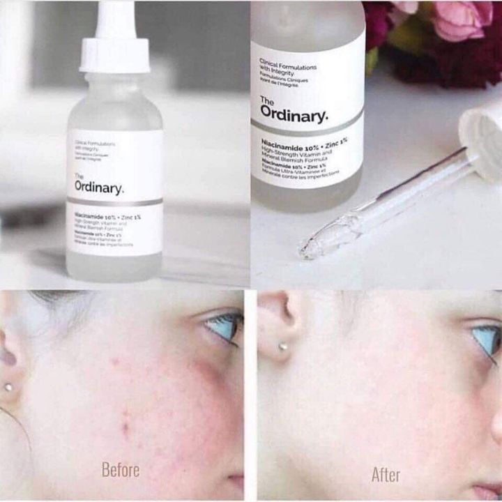 Serum ngừa mụn, sáng da, se khít Niacinamide 10% + Zinc 1% - The Ordinary 30ml