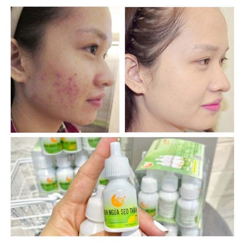 SERUM MỤN K3 Siêu Tốc 24h