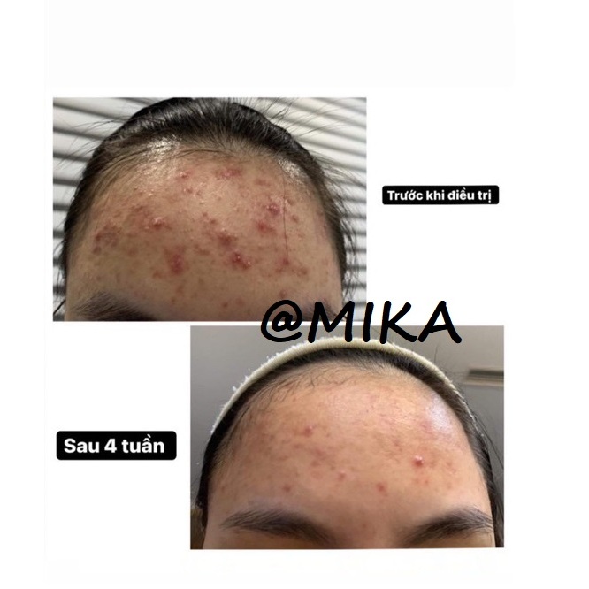 Chấm mụn TA DÔ da liễu kê đơn 0.1 0.3 C Gel MỤN ẨN, MỤN LI TI SƯNG VIÊM...