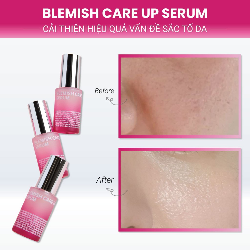 Tinh chất ISOI Blemish Care Up Serum giúp sáng da, hỗ trợ mờ thâm nám, tàn nhang