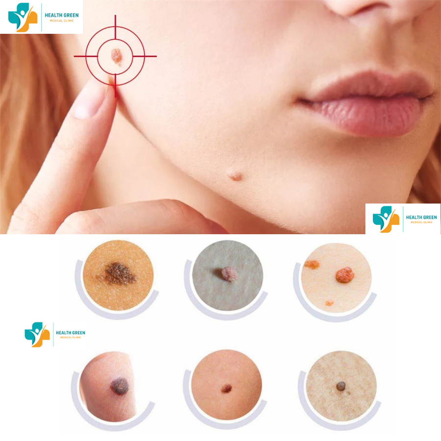 Loại bỏ - mụn cóc , mụn cơm, mắt cá chân, mụn thịt, nốt chai sần Viện Da Liễu - Acid Trichloracetic 80%