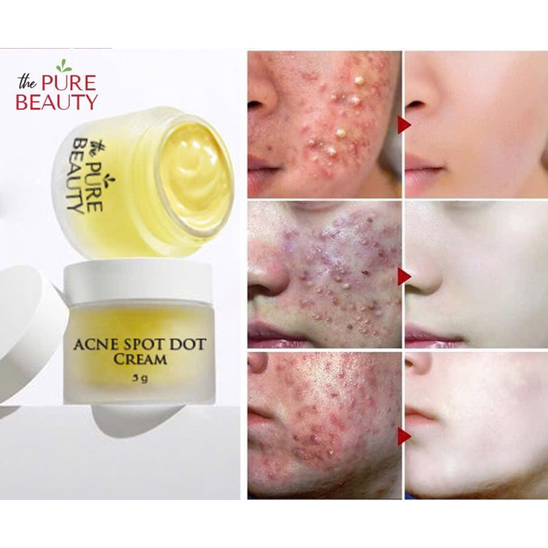 Kem Chấm Mụn Acne Spot Dot Cream