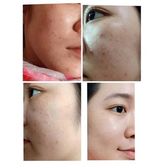 Kem Chấm Mụn Acne Spot Dot Cream