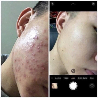Kem Chấm Mụn Acne Spot Dot Cream